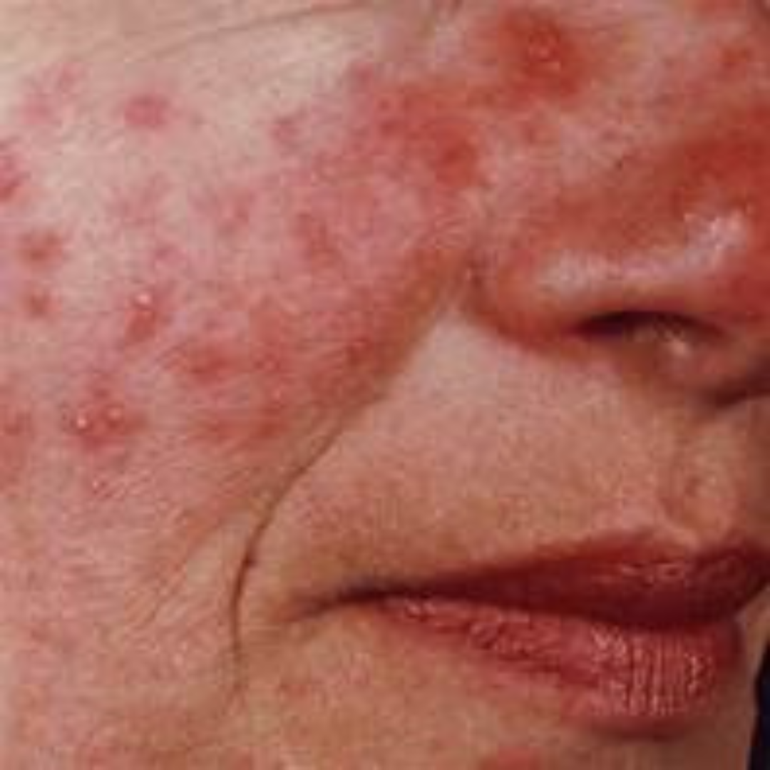 Featured image for “What We Know About the Causes of Rosacea”